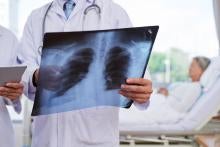 Investigación sobre tuberculosis